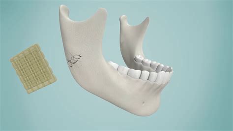  Resorbable Ceramic – Wytrzymałe i Biokompatybilne Materiały dla Medycyny Regeneracyjnej!